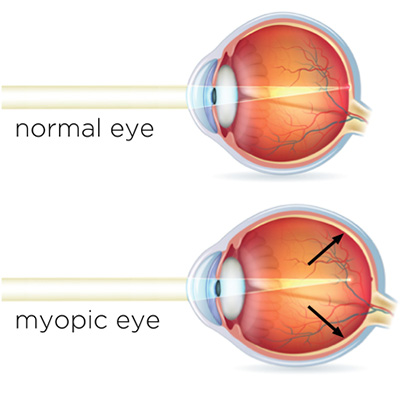 myopic eye